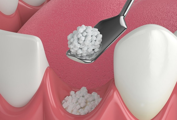 Bone grafting Seattle