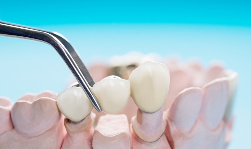 Dental Bridges Seattle