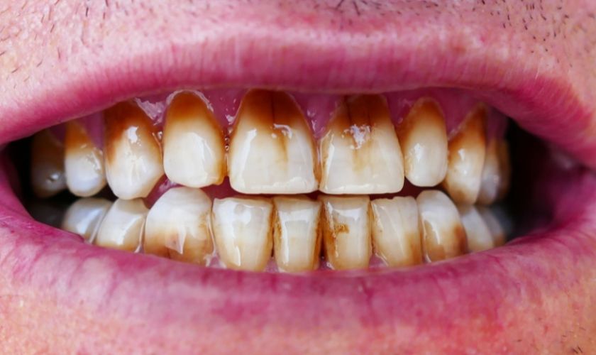 How Do You Get Coffee Stains Off Your Teeth Fast
