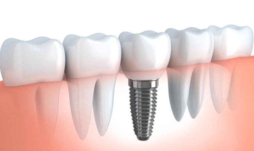 How Does A Dentist Fix A Failed Implant