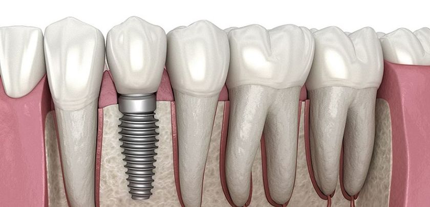 What Are The 3 Stages Of Dental Implant