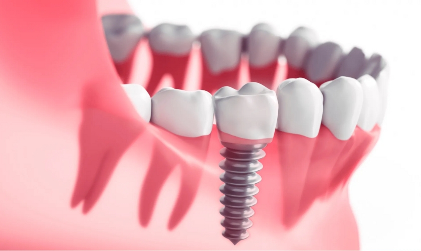 Signs Of A Failed Dental Implant