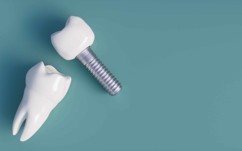 How Same-day implants ease dental anxiety