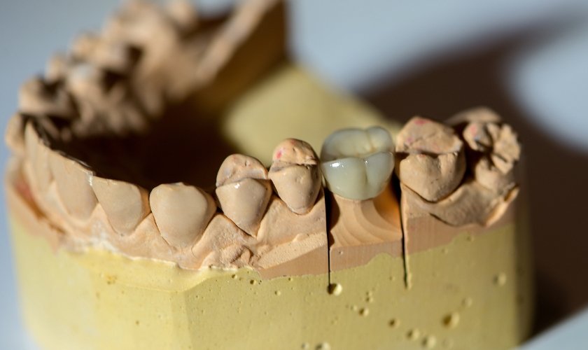 same-day crowns in San Leandro